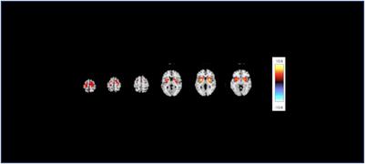 Fronto-striato network function is reduced in major depressive disorder